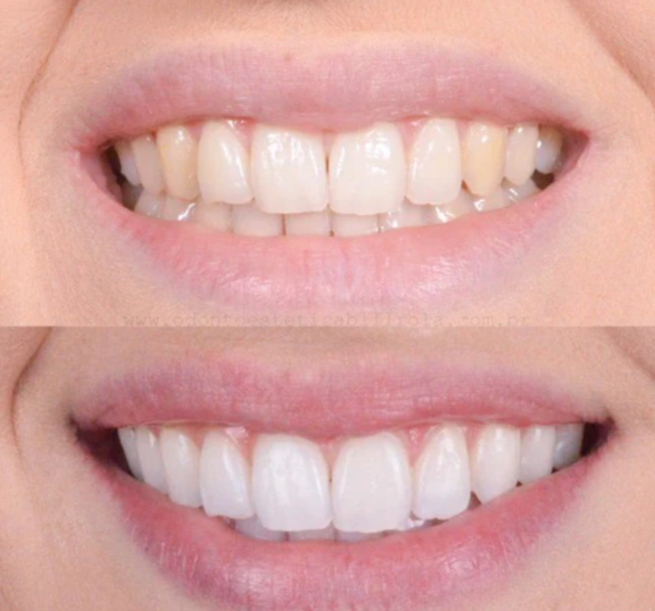 PerleHvid | Tandblekningspenna – Kliniskt inspirerad blekning hemma